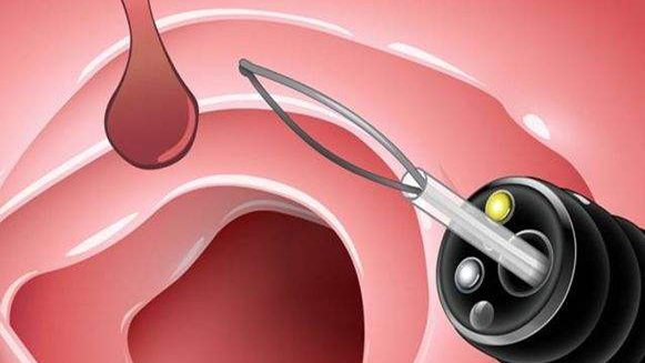 【健康解碼&middot;小貼士】檢查出息肉 需要切除嗎？