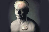 【健康解碼】起搏器真的能治好帕金森病嗎？